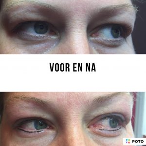 Een fijn lijntje boven en onder Foto net na behandeling